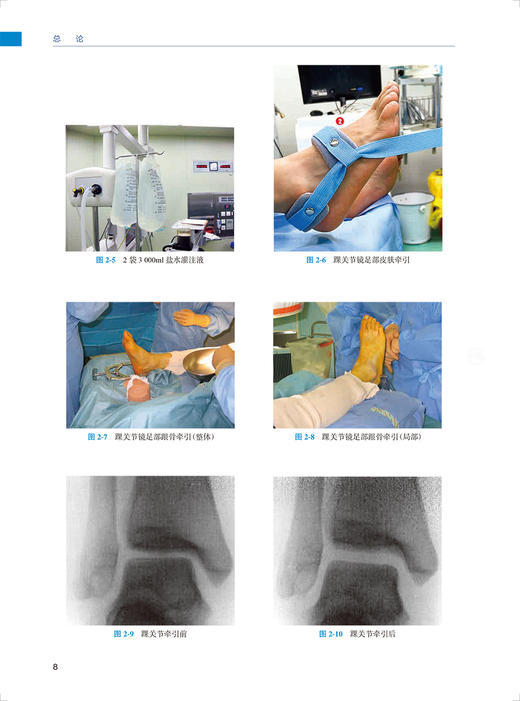 踝关节镜基础 潘海乐 华英汇 关节镜基本技术系列 临床常见疾病关节镜下治疗要点 手术特点必要准备 人民卫生出版社9787117347334 商品图3
