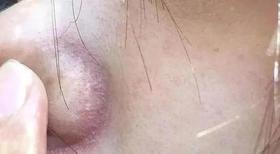 鼻翼两侧总泛红，可能是脂溢性皮炎！