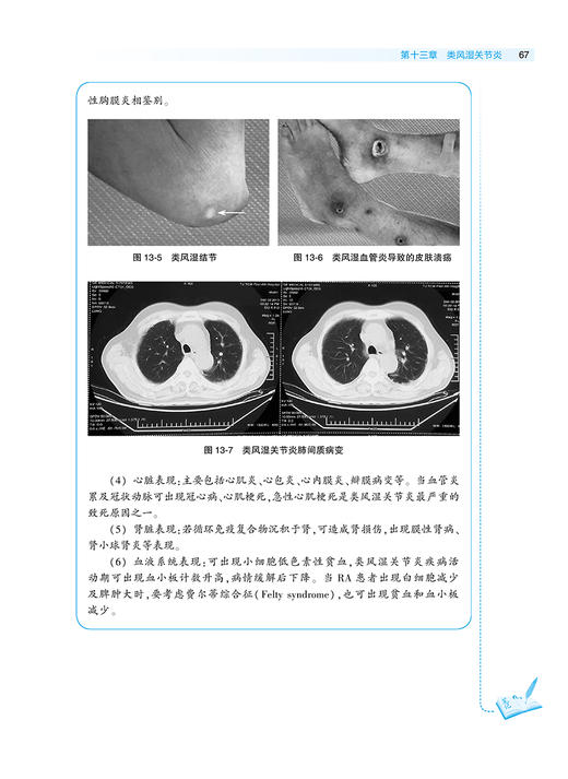 中医内科学 风湿分册 刘维 茅建春 国家健康委员会十三五规划教材 全国中医住院医师规范化培训教材 人民卫生出版社9787117341301 商品图3