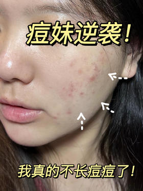 油皮宝子们集合🙈夏季油皮护肤思路！