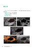 甲状腺疾病超声图解100例 张波 牛丽娟 罗渝昆 住院医师超声医学PBL教学培训系列教程 典型疾病经典超声图谱诊断 人民卫生出版社 商品缩略图3