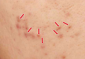 惊！隐藏十几年的祛红【秘密】，竟然有人爆料了！