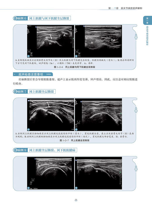 四肢肌骨经典病例超声解析 王月香主编 临床肌骨病例分析 经典超声图像解释 疾病超声诊断要点 科学技术文献出版社9787523504413 商品图3