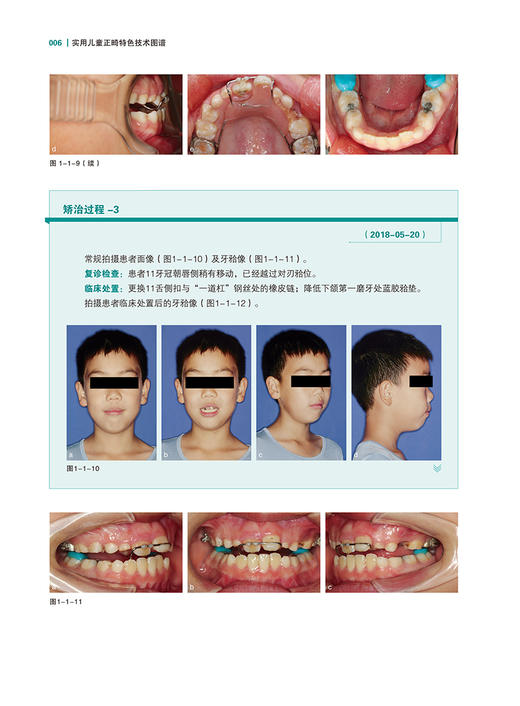 实用儿童正畸特色技术图谱 临床儿童早期矫治应用矫治器佩戴正畸操作规范牙齿矫正方案设计 辽宁科学技术出版社9787559130976 商品图4