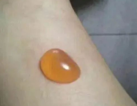  灸花不等于水泡，你可别小看它！ 