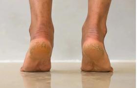  调理脚后跟干裂、小腿长干，其实很简单！ 