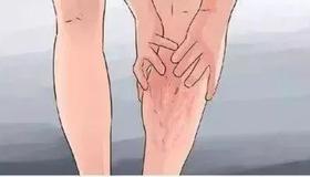  你知道腿梗吗？它的危害程度，都不亚于“心梗”和“脑梗”。 