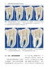 生物陶瓷材料在临床牙髓治疗中的应用 刘贺 喻健主译 亲水性硅酸钙材料临床应用 现代牙髓治疗技术 口腔科学 辽宁科学技术出版社 商品缩略图3
