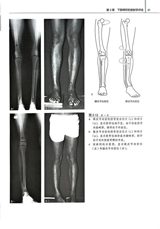 矫形外科原则 修订版 陈坚主译 配练习册 矫形外科经典著作 骨科畸形矫正截骨术 机械轴解剖轴术前计划CORA方法北京大学医学出版社 商品图4