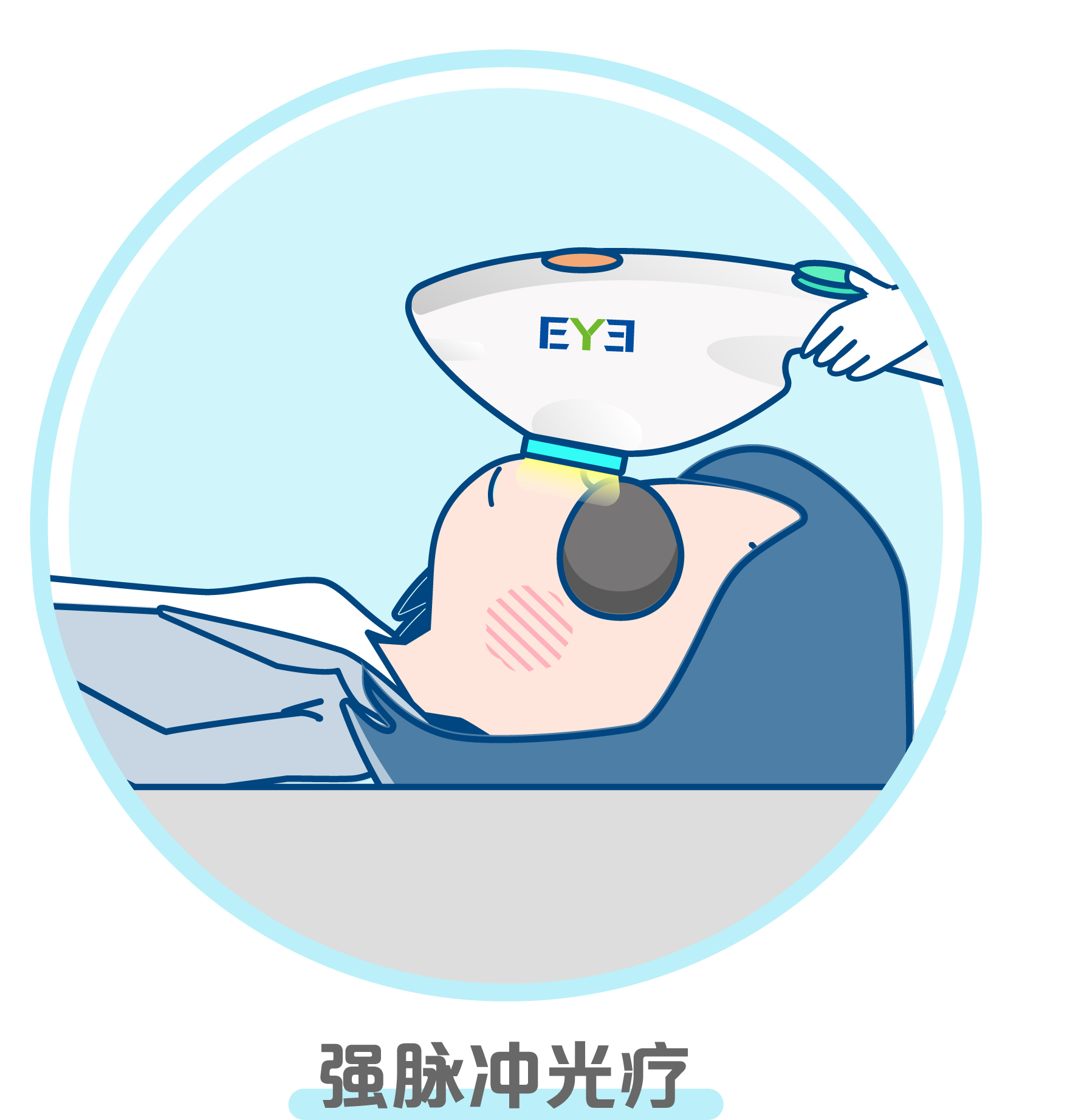 OPT强脉冲光 季卡