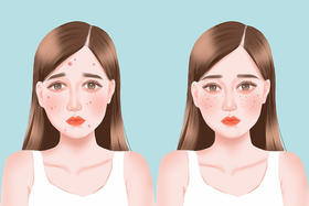 血瘀上脸全是斑，中医教你调淡它！