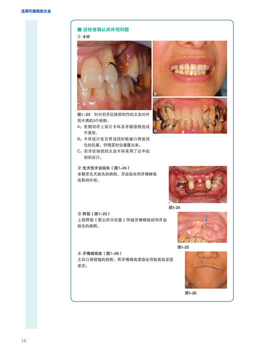 活用可摘局部义齿 从基本操作到灵活运用 和田淳一郎 顾洁 徐晓溪主译 活用可摘局部义齿实际方法 口腔修复 辽宁科学技术出版社 商品图4