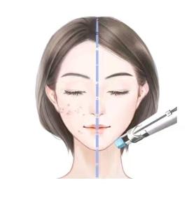 【合规三类械】水光针！娃娃针/薇旖美/新肤泉胶原蛋白