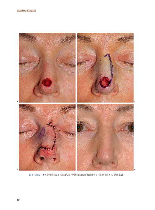 面部整形重建原则 第3版 傅窈窈 面部整形修复 解剖结构皮瓣技术 实际病例手术方法过程 眼耳鼻整形外科医师参考书 人民卫生出版社 商品图4