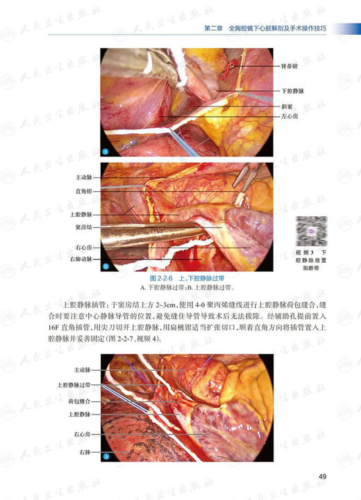 全胸腔镜心脏手术与围手术期管理 附视频 张晓慎 肖学钧 梁贵友 心脏手术步骤技术及注意要点 围手术期处理麻醉 人民卫生出版社 商品图3