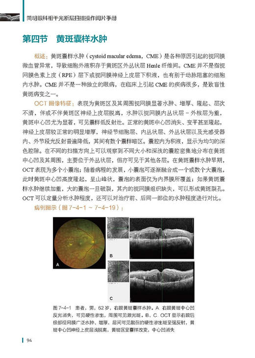 简明眼科相干光断层扫描操作阅片手册 王占平 朝聚眼科医院集团眼科检查系列丛书 OCT影像技术基本操作指导 北京科学技术出版社 商品图3