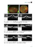 简明眼科相干光断层扫描操作阅片手册 王占平 朝聚眼科医院集团眼科检查系列丛书 OCT影像技术基本操作指导 北京科学技术出版社 商品缩略图4