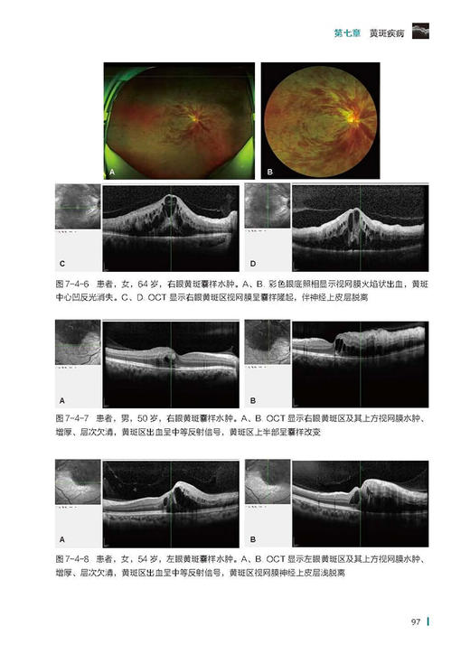 简明眼科相干光断层扫描操作阅片手册 王占平 朝聚眼科医院集团眼科检查系列丛书 OCT影像技术基本操作指导 北京科学技术出版社 商品图4