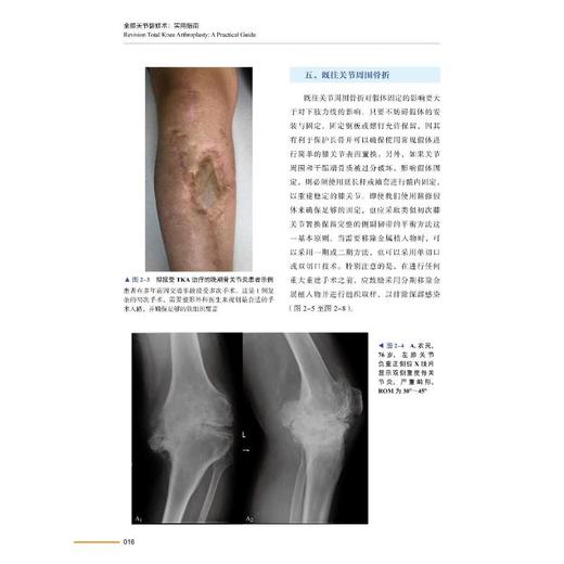 全膝关节翻修术 实用指南 商品图2