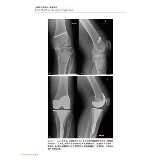 全膝关节翻修术 实用指南 商品图1