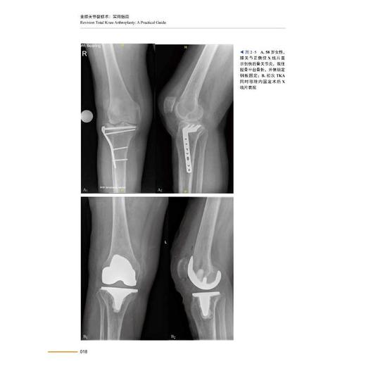 全膝关节翻修术 实用指南 商品图3