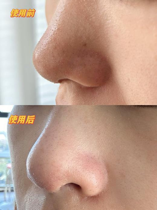 【2件减5元】【黑油消消乐】柏翠丝鼻膜 高能围剿黑头、粉刺、白头...堵塞毛孔的脏东西清理干干净净~湖州仓 商品图4