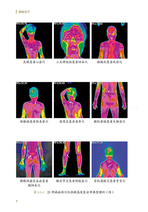 热敏灸学 陈日新 谢丁一著 热敏灸理论技术操作 热敏灸优势病症治疗方案防治知识方法临床案例 中医学9787117352352人民卫生出版社 商品图3