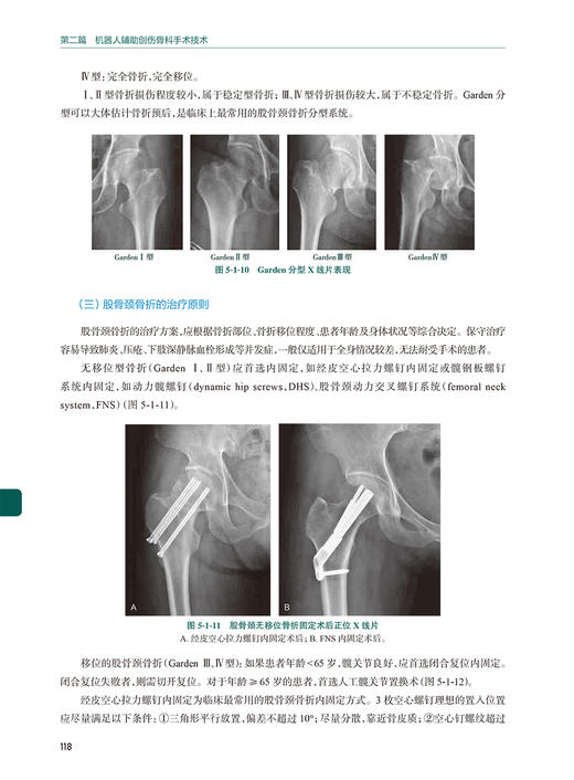 机器人辅助创伤骨科手术技巧 蒋协远 王军强 机器人背景原理操作技术 天玑骨科手术机器人进行常见手术标准操作流程人民卫生出版社 商品图4