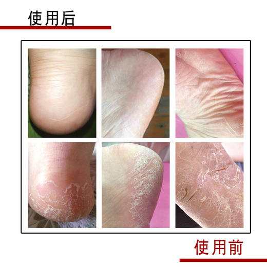 女士松口防裂袜足跟型 中筒袜 纯色乳胶防裂四季款棉袜 缓解干裂脚跟疼痛 告别脚裂脚干烦恼 5双/盒装 商品图1