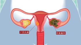  预防肌瘤与囊肿，不妨试试这几个穴位 