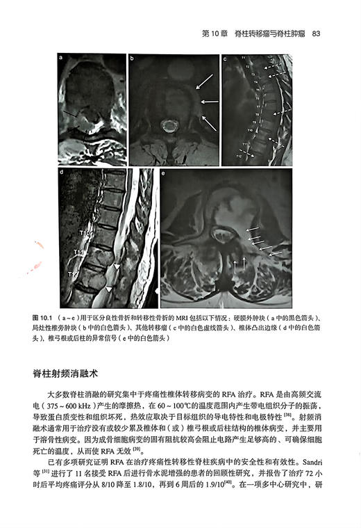 脊柱与关节射频消融治疗技术 樊碧发等译 脊柱关节疾病常见疼痛射频治疗方法操作技术要点影像学 北京大学医学出版社9787565930089 商品图3
