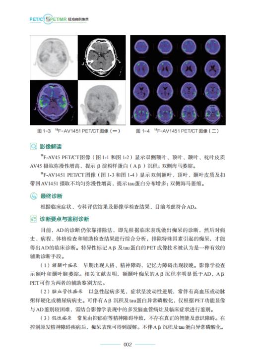 PET/CT与PET/MR疑难病例集萃/临床病例精析丛书/赵葵/潘建虎/张联合/楼岑/邵国良/程爱萍/褚玉/王祖飞/浙江大学出版社 商品图2