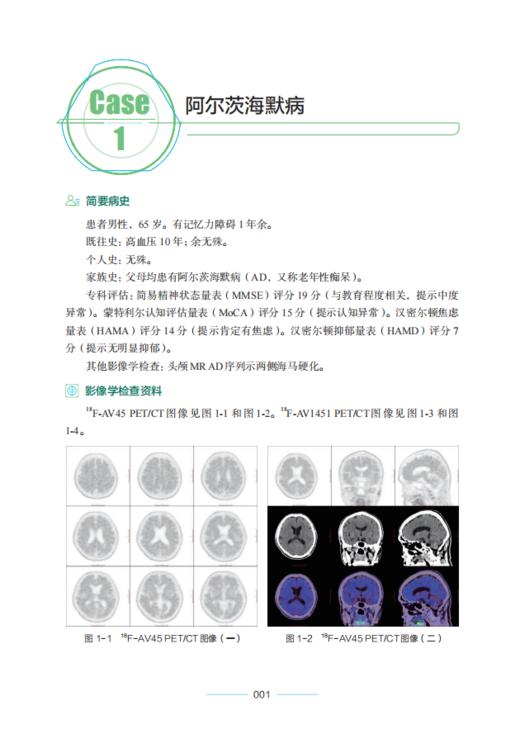 PET/CT与PET/MR疑难病例集萃/临床病例精析丛书/赵葵/潘建虎/张联合/楼岑/邵国良/程爱萍/褚玉/王祖飞/浙江大学出版社 商品图1
