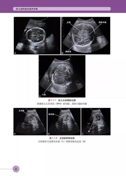 胎儿磁共振及超声诊断 胎儿MRI及超声应用价值 前置胎盘粘连或胎盘植入 侧脑室单侧扩大 绒毛膜血管瘤 科学出版社9787030767530 商品图4