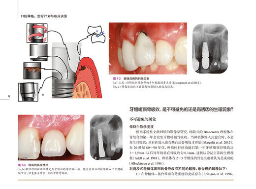 口腔种植 治疗计划与临床决策 宿玉成主译 口腔牙种植前方案设计选择讲解 种植体及相应移植方案适应证与临床效果 人民卫生出版社 商品图2