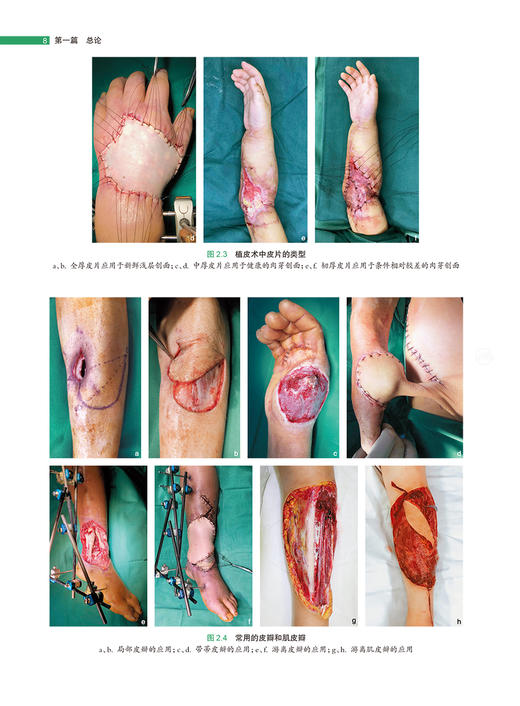 创面修复图解 杨勇 沈余明  刘元波 创面修复原则方法手术方式 器官重建常用皮瓣肌皮瓣切取步骤应用场景 临床病例 人民卫生出版社 商品图4