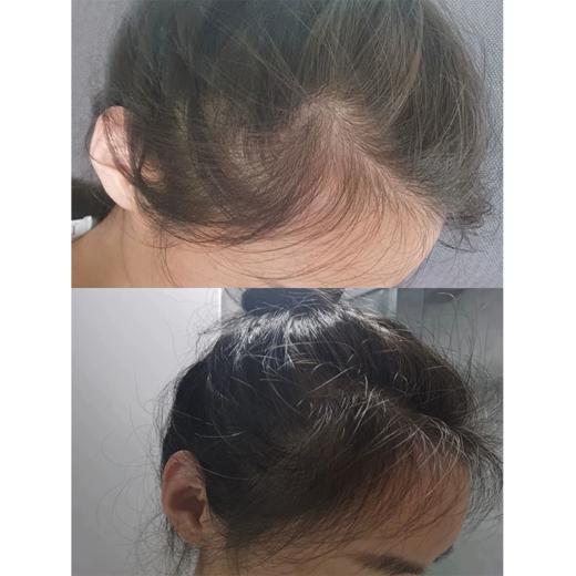 【中欧班列精选3瓶】土耳其进口BIOXCIN 柏科生防脱增发头皮养护强韧发根精华素50ml*3瓶/洗发水300ml*3瓶 商品图14