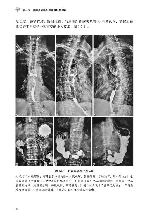 肠内营养通路构建 介入技术临床应用点津 杨光 张静 以介入手段主导的肠内营养通路构建方法 术中护理9787117355636人民卫生出版社 商品图4