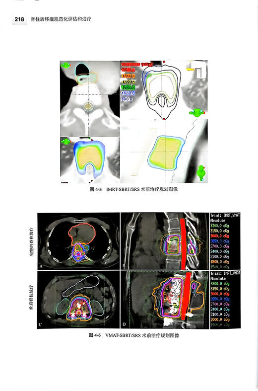 脊柱转移瘤规范化评估和治疗 肖建如 许炜 脊柱转移癌发生机制临床特征外科手术入路辅助全身治疗9787565929021北京大学医学出版社 商品图4