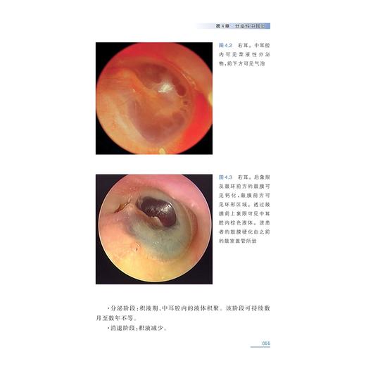 耳镜发现/国际医学研究前沿优秀译著/[斯洛文]雅奈兹·雷博尔 著/王耀文 唐世雄 译/浙江大学出版社/引进版/专著/耳鼻咽喉科 商品图4