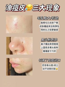 鼻子干干净净👋🏻毛孔从没这么干净过！