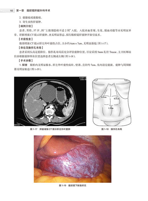 腹腔镜肝胆胰脾手术难点与技巧 附视频 胡智明 黄东胜 外科手术操作概论步骤细节要点难点技巧和经验 人民卫生出版社9787117355797 商品图4