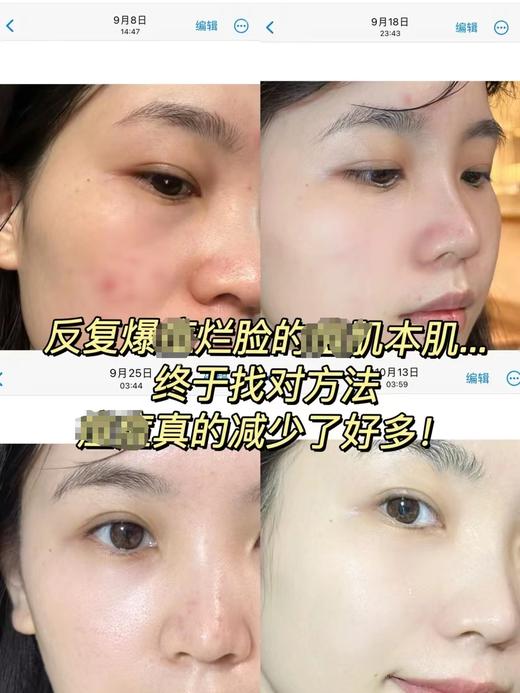 【清仓好价】Cosmedix科斯美蒂Clarity净痘精华30ml淡痘印（效期至24.9） 商品图2