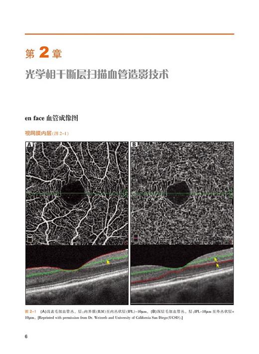 光学相干断层扫描血管造影图谱 病例研究 一本内容丰富实用的OCTA指导手册配有100余幅高质量图片天津科技翻译出版公9787543343757 商品图3