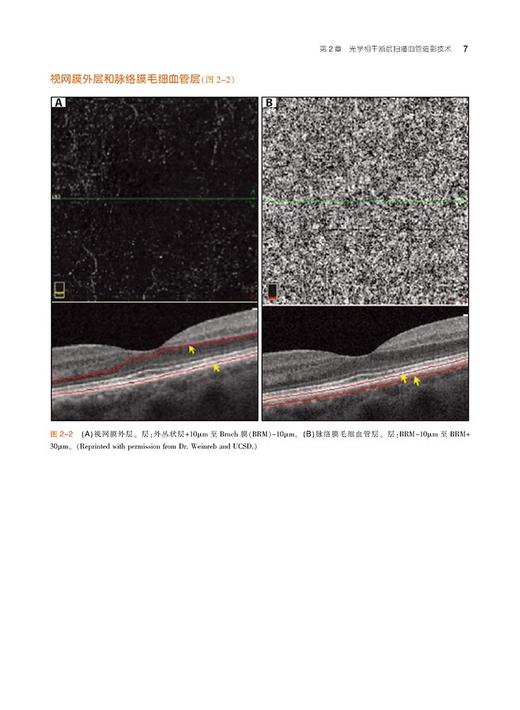 光学相干断层扫描血管造影图谱 病例研究 一本内容丰富实用的OCTA指导手册配有100余幅高质量图片天津科技翻译出版公9787543343757 商品图4
