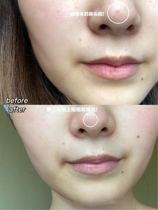 【清仓好价】kate凯诗薇祛痘精华ks小粉瓶点涂水杨酸30ml 商品图3