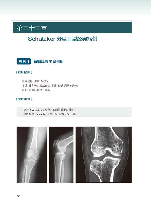 胫骨平台骨折精准微创治疗学 阐述了胫骨平台骨折的系统解剖学 生物力学 流行病学 诊断和微创治疗等人民卫生出版社9787117357241 商品图4