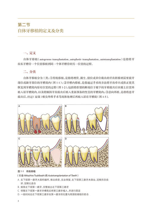 自体牙移植手术图谱 侯锐编 口腔牙科种植手术评估操作预防根管治疗口腔科学临床病例医师参考书 人民卫生出版社9787117357289 商品图4