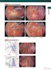 进展期结直肠癌盆腔手术图谱 王利明 姚力 主译 扫描二维码可查看附赠视频 手术技术难点 辽宁科学技术出版社9787559132222 商品缩略图4