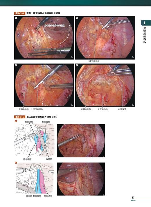 进展期结直肠癌盆腔手术图谱 王利明 姚力 主译 扫描二维码可查看附赠视频 手术技术难点 辽宁科学技术出版社9787559132222 商品图4